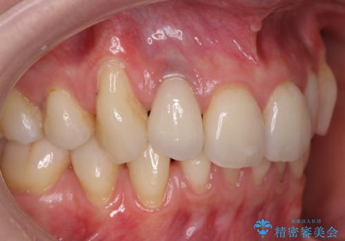 前歯の形と変色が気になる。 ジルコニアクラウンでの修復処置の症例 治療後