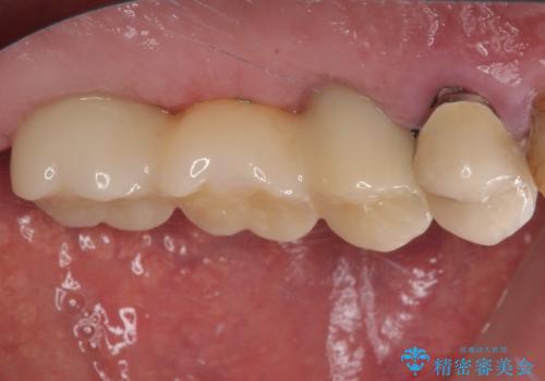 割れてしまった奥歯 抜歯即時埋入インプラントによる短期間治療の治療前