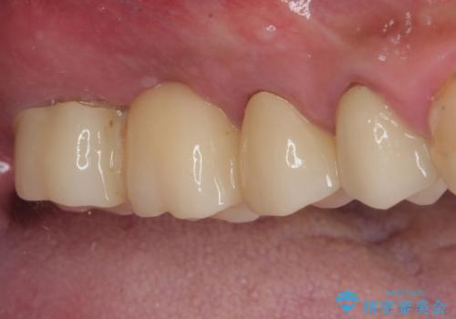 割れてしまった奥歯 抜歯即時埋入インプラントによる短期間治療の治療前