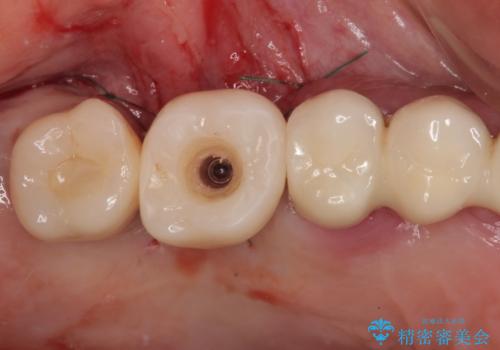 抜けてしまった奥歯 短期間インプラント治療の治療中
