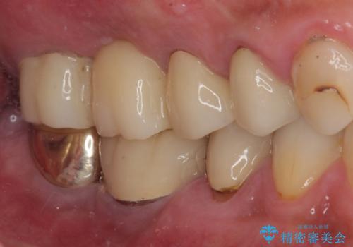 割れてしまった奥歯 抜歯即時埋入インプラントによる短期間治療の治療前