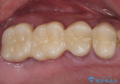 割れてしまった奥歯 抜歯即時埋入インプラントによる短期間治療の症例 治療前