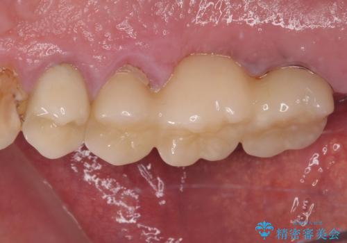 割れてしまった奥歯 抜歯即時埋入インプラントによる短期間治療の治療前