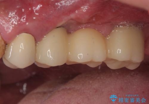 割れてしまった奥歯 抜歯即時埋入インプラントによる短期間治療の治療前