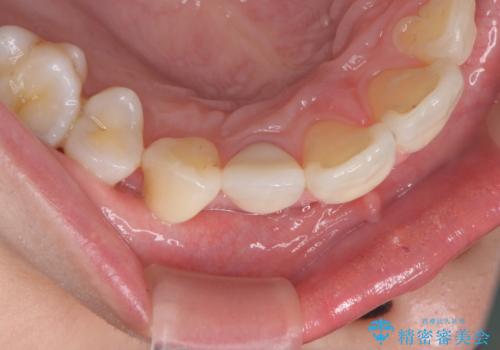 前歯の形と変色が気になる。 ジルコニアクラウンでの修復処置の治療後