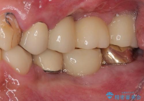 割れてしまった奥歯 抜歯即時埋入インプラントによる短期間治療の治療前
