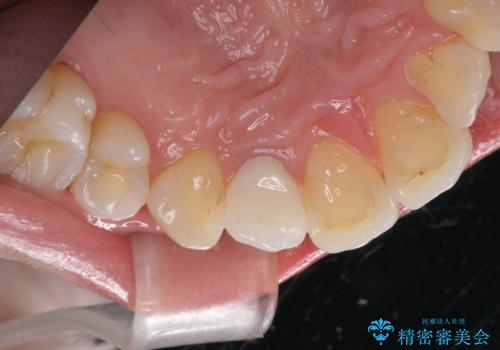 前歯の形と変色が気になる。 ジルコニアクラウンでの修復処置の治療後