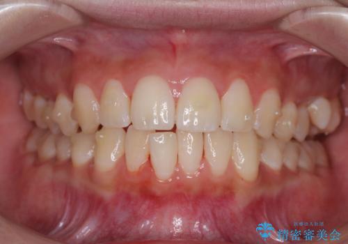 目立たないマウスピース矯正で下の前歯のデコボコをスッキリ解消!たった1年で整った歯並びにの治療中