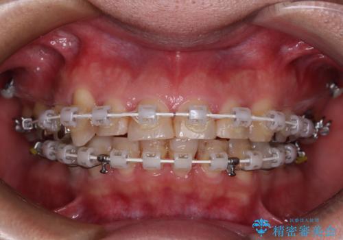 銀歯を白くしたい 一緒に矯正治療も行ない美しい口腔内にの治療中