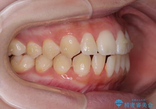 目立たないマウスピース矯正で下の前歯のデコボコをスッキリ解消!たった1年で整った歯並びにの治療中