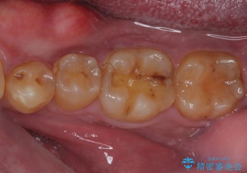 咬合力で破折した奥歯 抜歯即時埋入インプラントによる補綴治療の症例 治療前