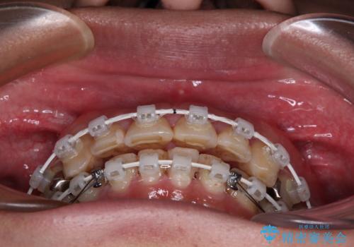 銀歯を白くしたい 一緒に矯正治療も行ない美しい口腔内にの治療中