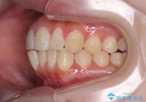 目立たないマウスピース矯正で下の前歯のデコボコをスッキリ解消!たった1年で整った歯並びにの治療中