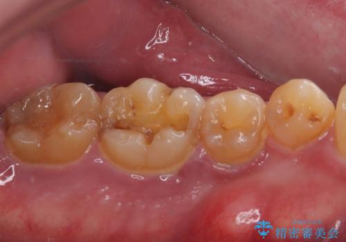 咬合力で破折した奥歯 抜歯即時埋入インプラントによる補綴治療の治療前