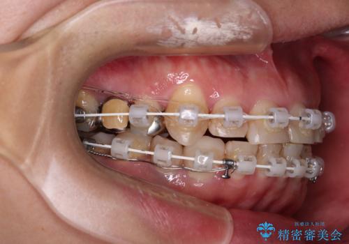 銀歯を白くしたい 一緒に矯正治療も行ない美しい口腔内にの治療中