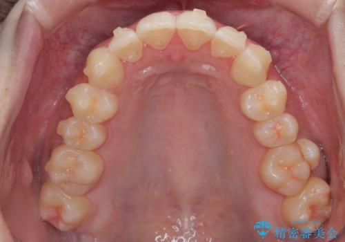 目立たないマウスピース矯正で下の前歯のデコボコをスッキリ解消!たった1年で整った歯並びにの治療中