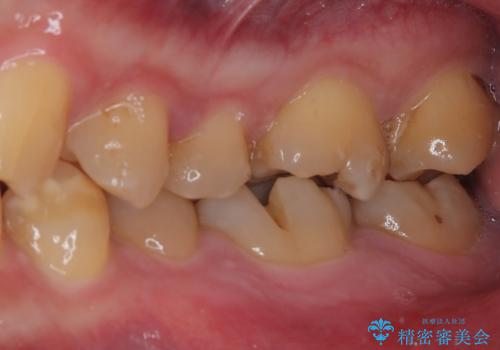 咬合力で破折した奥歯 抜歯即時埋入インプラントによる補綴治療の治療前