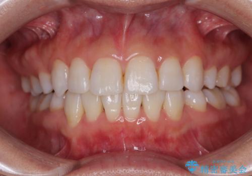 矯正治療の後戻り インビザラインで短期間矯正治療の治療後