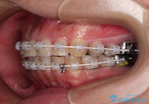 銀歯を白くしたい 一緒に矯正治療も行ない美しい口腔内にの治療中