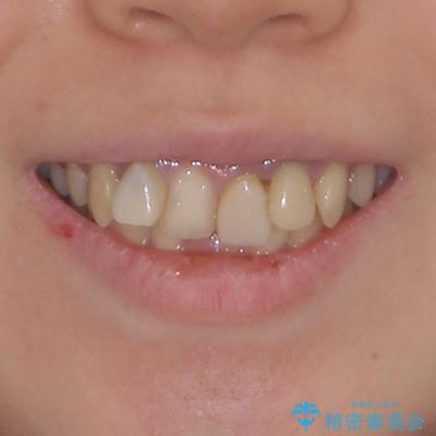 気になっていたむし歯と前歯のデコボコ 矯正治療とむし歯治療の総合歯科治療の治療前(顔貌)