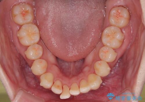 目立たないマウスピース矯正で下の前歯のデコボコをスッキリ解消!たった1年で整った歯並びにの治療中