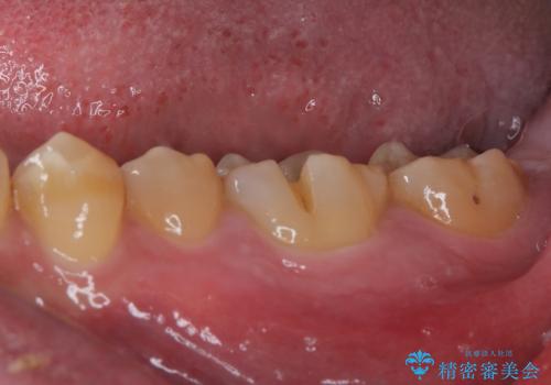 咬合力で破折した奥歯　抜歯即時埋入インプラントによる補綴治療の治療前
