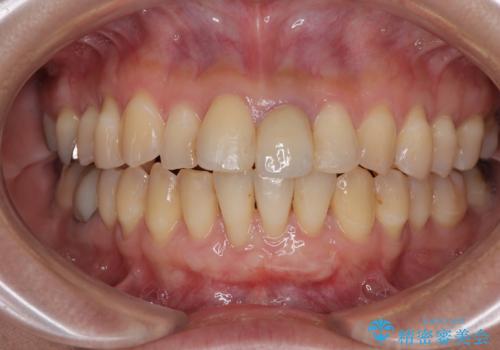 矯正治療で退縮した歯肉 歯肉移植術で露出した歯根を覆い隠すの治療後
