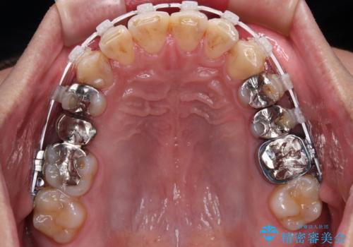 銀歯を白くしたい 一緒に矯正治療も行ない美しい口腔内にの治療中