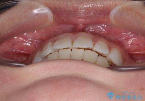 矯正治療の後戻り インビザラインで短期間矯正治療の治療後