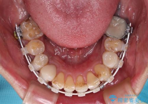 銀歯を白くしたい 一緒に矯正治療も行ない美しい口腔内にの治療中
