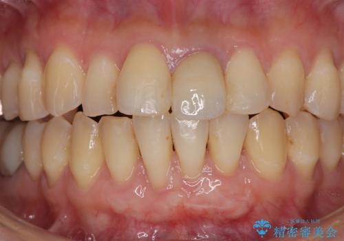 矯正治療で退縮した歯肉 歯肉移植術で露出した歯根を覆い隠すの治療後