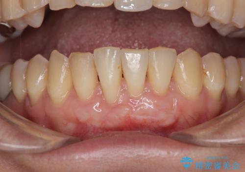 矯正治療で退縮した歯肉 歯肉移植術で露出した歯根を覆い隠すの症例 治療後