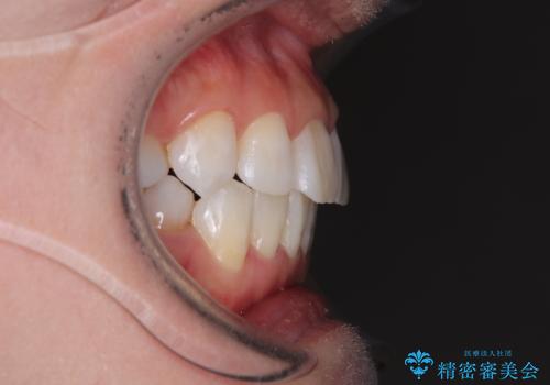 矯正治療の後戻り インビザラインで短期間矯正治療の治療後