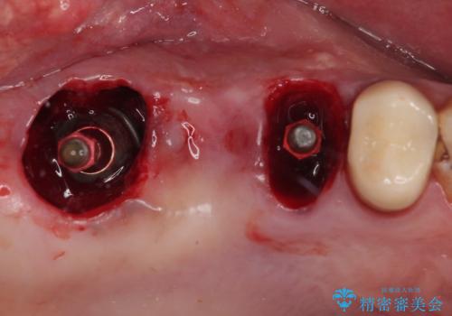 割れてしまった奥歯 抜歯即時埋入インプラントによる短期間治療