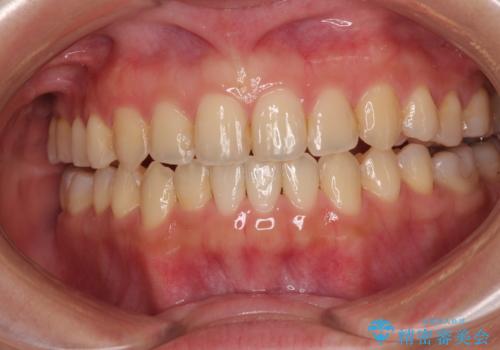 前歯のオープンバイト インビザラインで咬み合わせを改善の症例 治療後