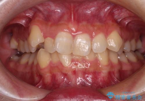 気になる八重歯 ワイヤー装置での抜歯矯正