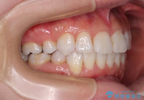 矯正治療の後戻り インビザラインで短期間矯正治療の治療後