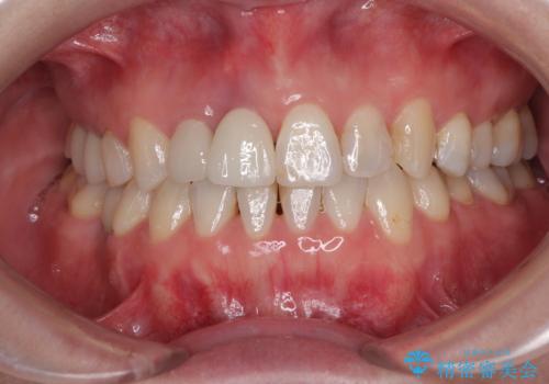 破折した前歯のインプラント 1DAYインプラントで短期間治療の治療後