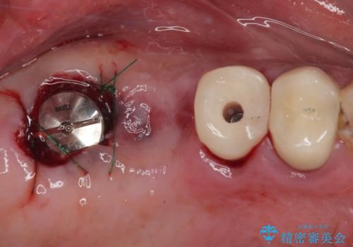 割れてしまった奥歯 抜歯即時埋入インプラントによる短期間治療の治療中