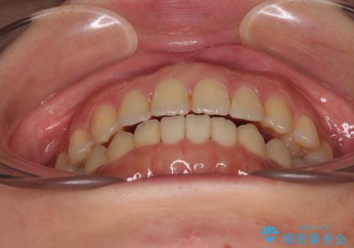 前歯のオープンバイト インビザラインで咬み合わせを改善の治療後