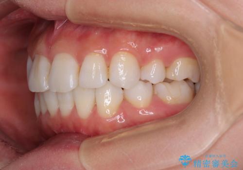矯正治療の後戻り インビザラインで短期間矯正治療の治療後
