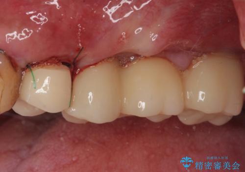 割れてしまった奥歯 抜歯即時埋入インプラントによる短期間治療の治療中