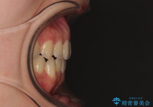 前歯のオープンバイト インビザラインで咬み合わせを改善の治療後