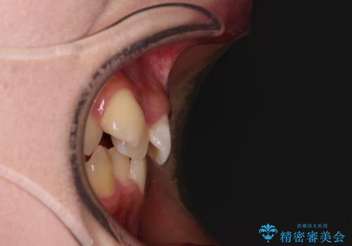 気になる八重歯 ワイヤー装置での抜歯矯正の治療前
