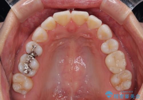 矯正治療の後戻り インビザラインで短期間矯正治療の治療後