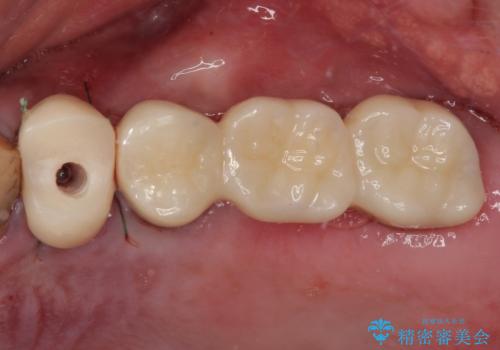 割れてしまった奥歯 抜歯即時埋入インプラントによる短期間治療の治療中