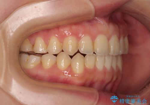 前歯のオープンバイト インビザラインで咬み合わせを改善の治療後