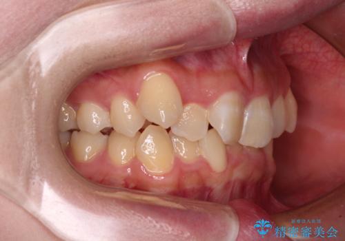 気になる八重歯 ワイヤー装置での抜歯矯正の治療前