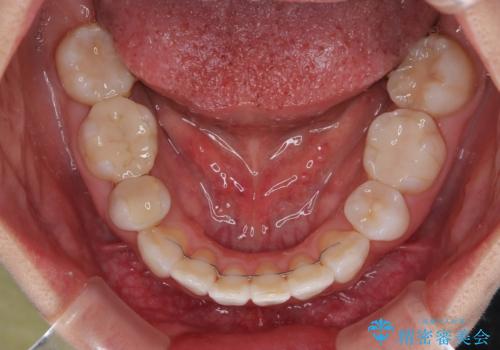 矯正治療の後戻り インビザラインで短期間矯正治療の治療後