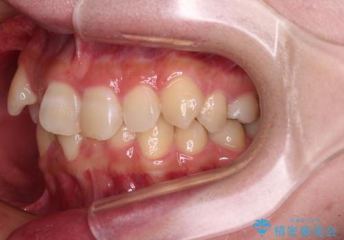 気になる八重歯 ワイヤー装置での抜歯矯正の治療前